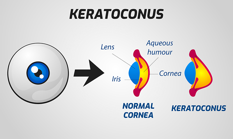 keratoconus2view